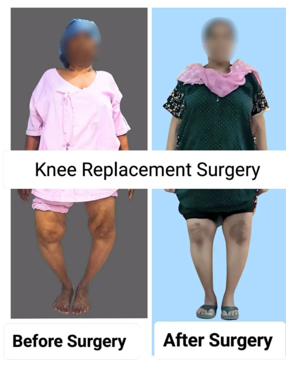 It Represents Knee Replacement Surgery Before After