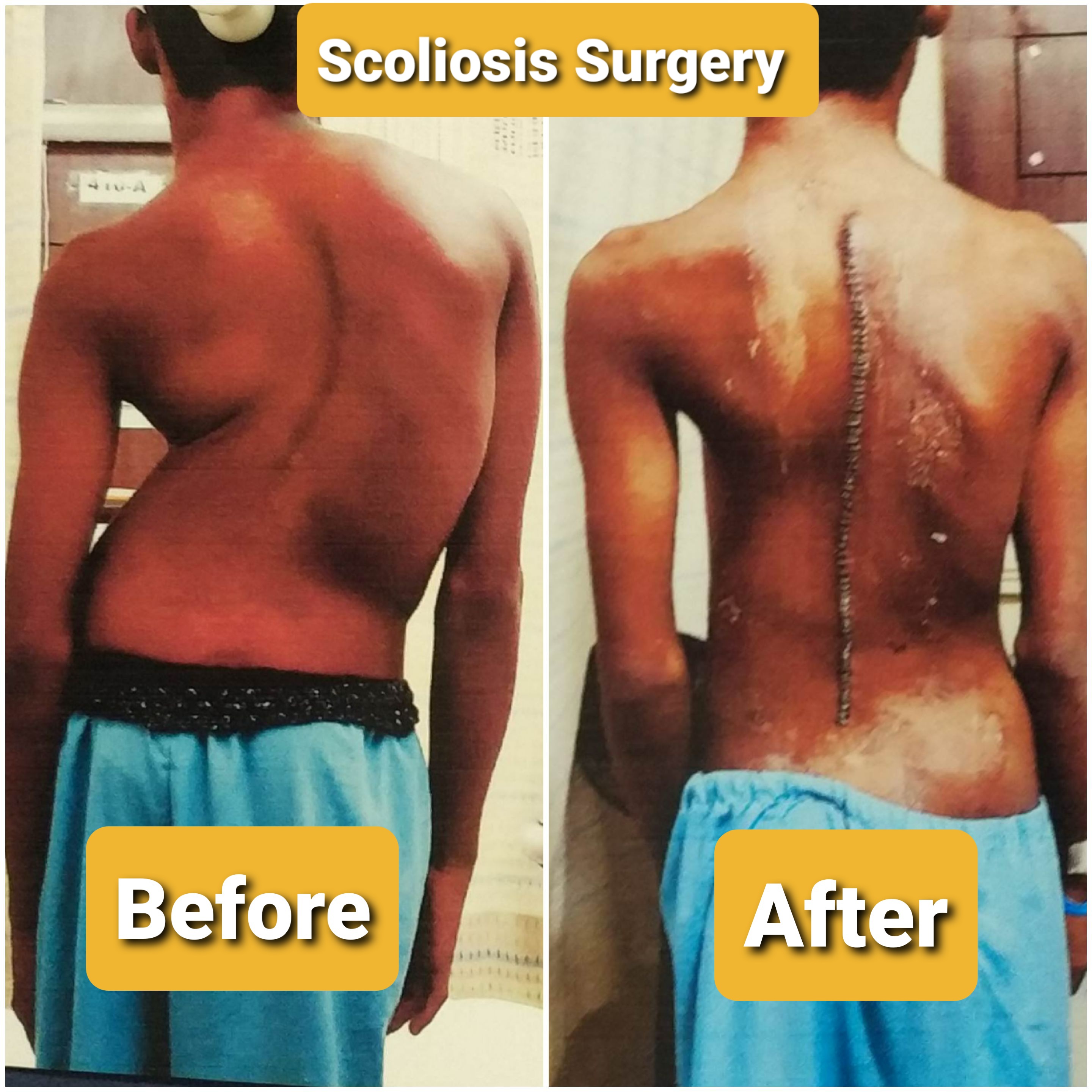 Scoliosis Surgery In Delhi NCR Noida Advanced Treatment For Spinal 